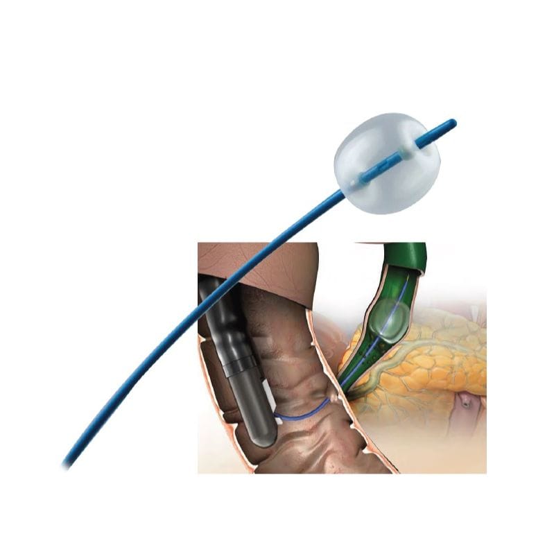 Balón De Extracción De Cálculos Biliares