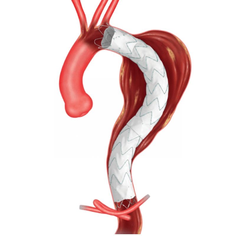 Injerto endovascular torácico