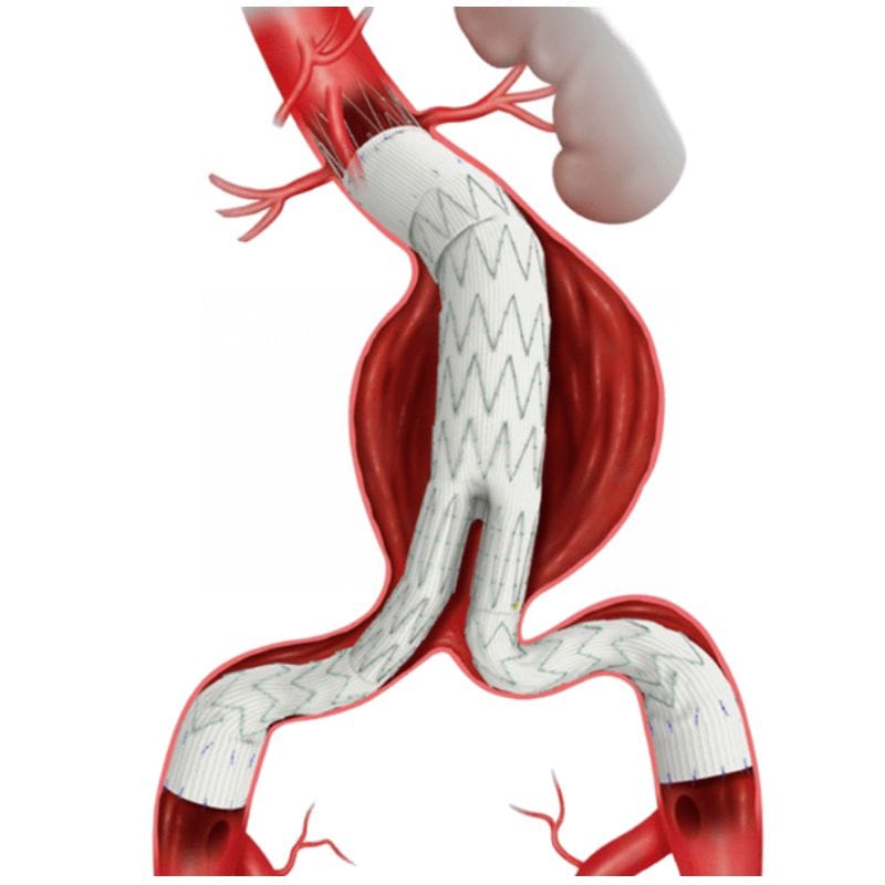 Prótesis endovascular Prótesis de cuerpo principal bifurcado AAA