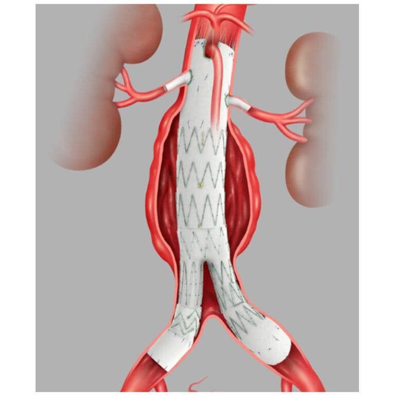Proximal Aaa Alquiler y Venta Prótesis endovascular, cuerpo bifurcado distal y ...